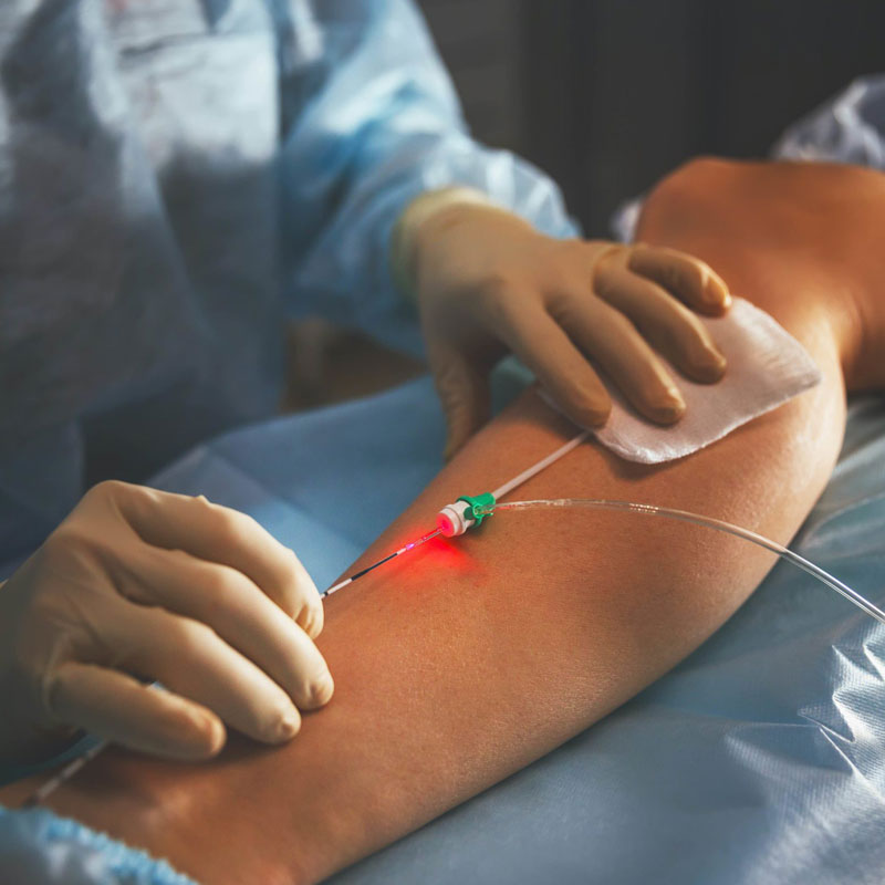 Bénéfices et effets du laser endoveineux